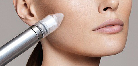 Mikrodermabrasion in Marbella - Beautyworld Marbella